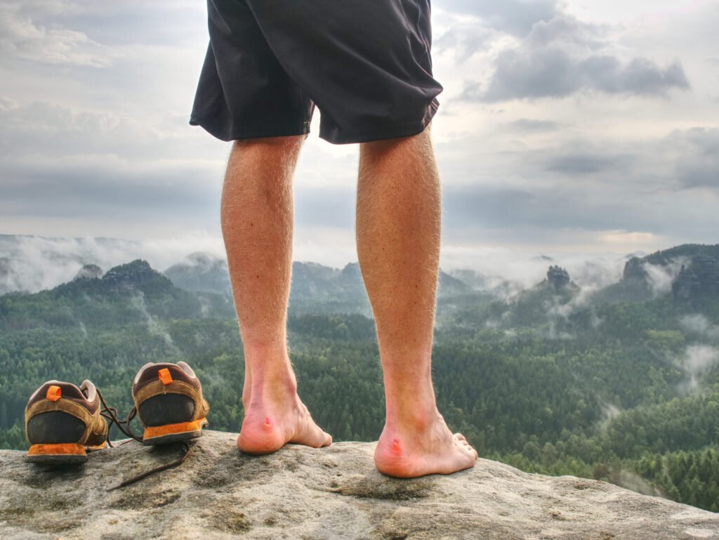 Preventing Blisters on Long-Distance Hikes